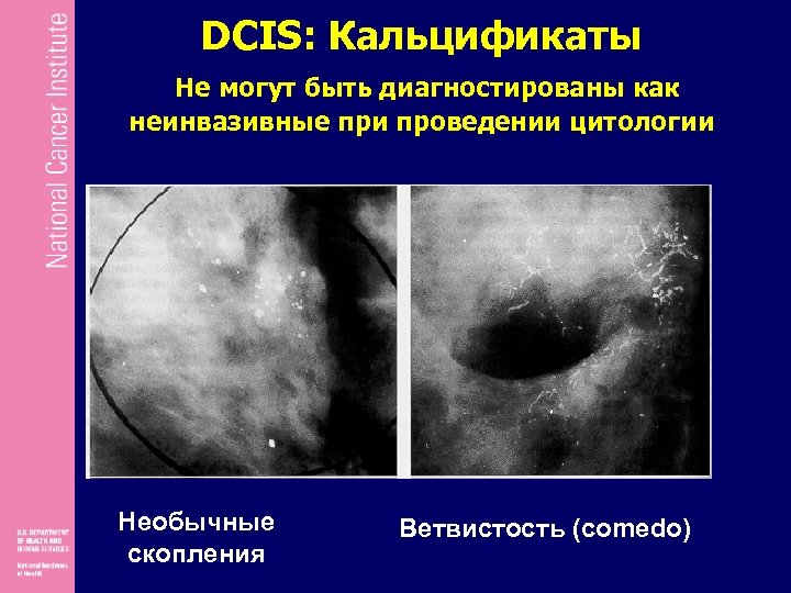 DCIS: Кальцификаты Не могут быть диагностированы как неинвазивные при проведении цитологии Необычные скопления Ветвистость