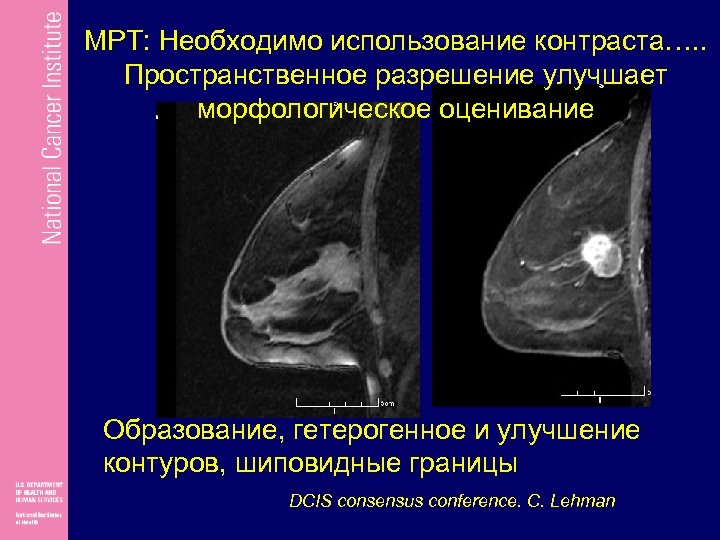 MРТ: Необходимо использование контраста…. . Пространственное разрешение улучшает морфологическое оценивание Образование, гетерогенное и улучшение