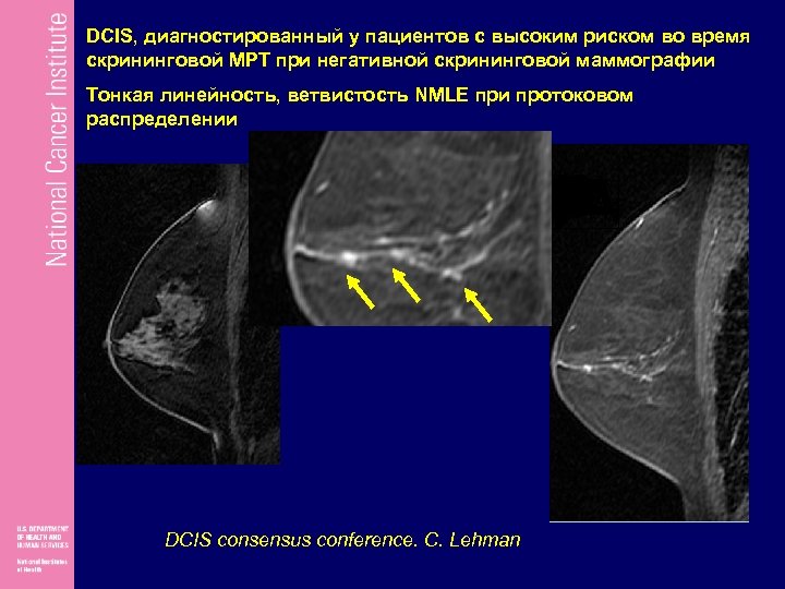 DCIS, диагностированный у пациентов с высоким риском во время скрининговой МРТ при негативной скрининговой