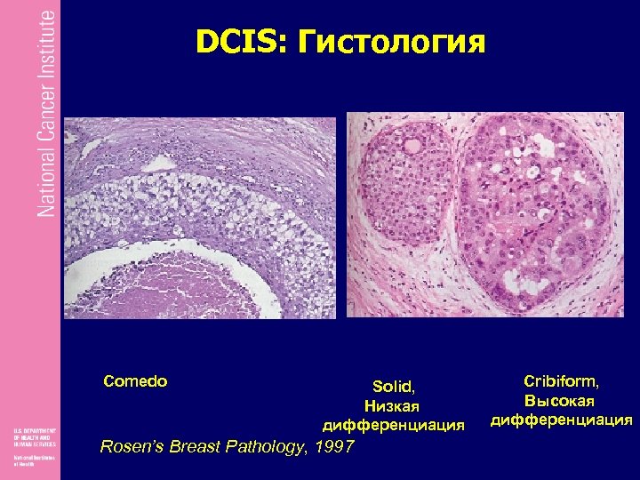 Протоковая карцинома in situ молочной. Протоковая карцинома in situ. Карцинома ин ситу гистология. Дифференциация гистология.