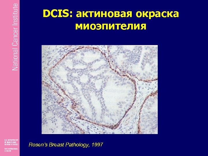 DCIS: актиновая окраска миоэпителия Rosen’s Breast Pathology, 1997 