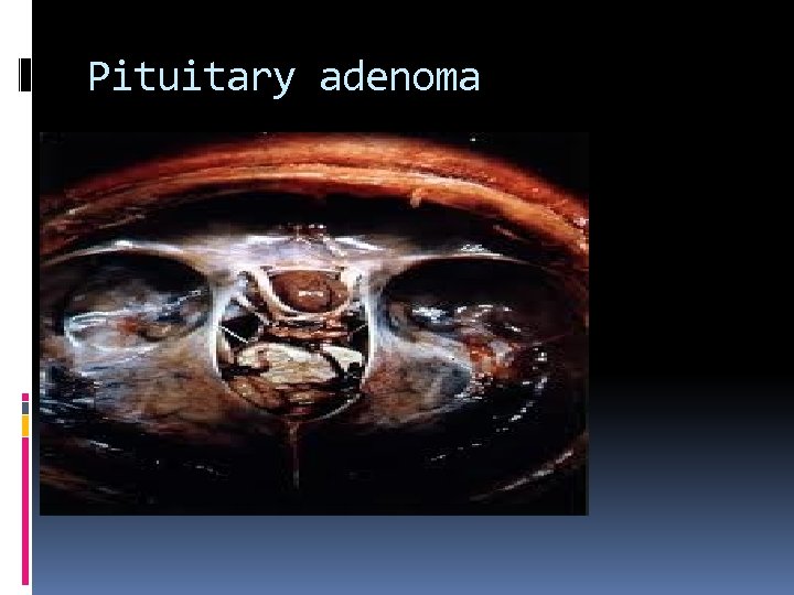 Pituitary adenoma 