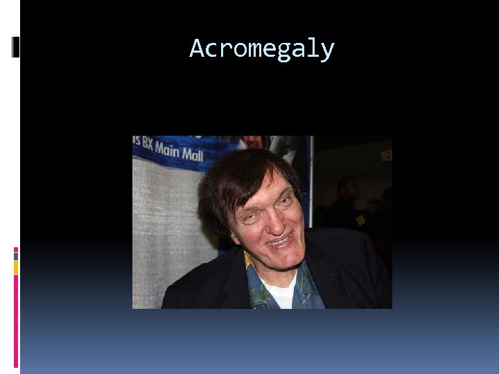 Acromegaly 