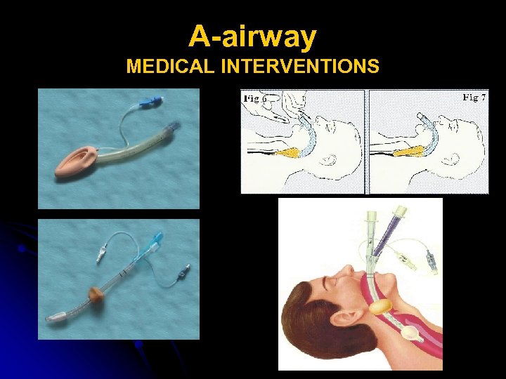 A-airway MEDICAL INTERVENTIONS 