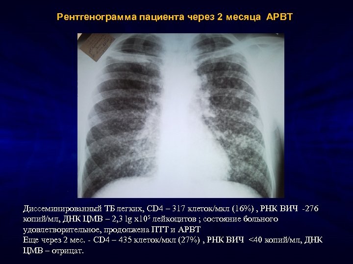 Рентгенограмма пациента через 2 месяца АРВТ Диссеминированный ТБ легких, CD 4 – 317 клеток/мкл