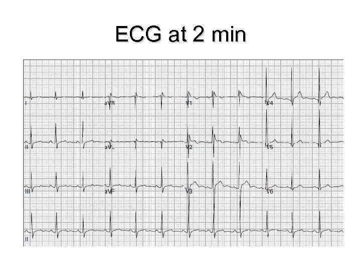 ECG at 2 min 