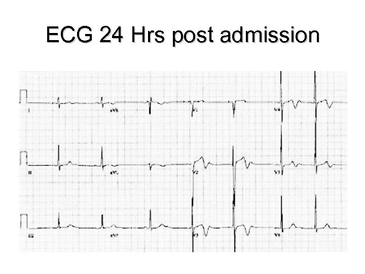 ECG 24 Hrs post admission 