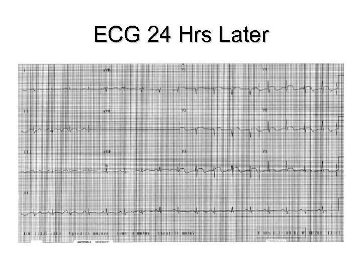 ECG 24 Hrs Later 