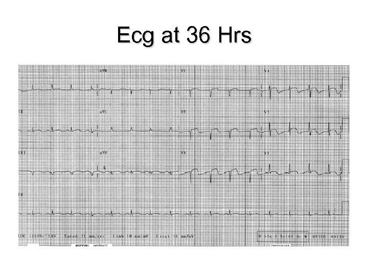 Ecg at 36 Hrs 