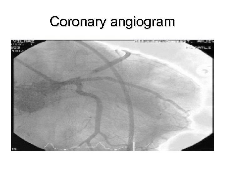 Coronary angiogram 