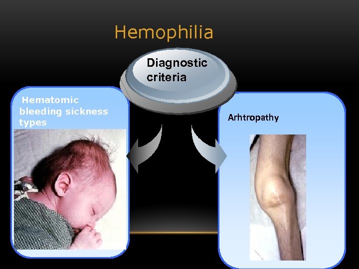 Hemophilia Diagnostic criteria Hematomic bleeding sickness types Arhtropathy 