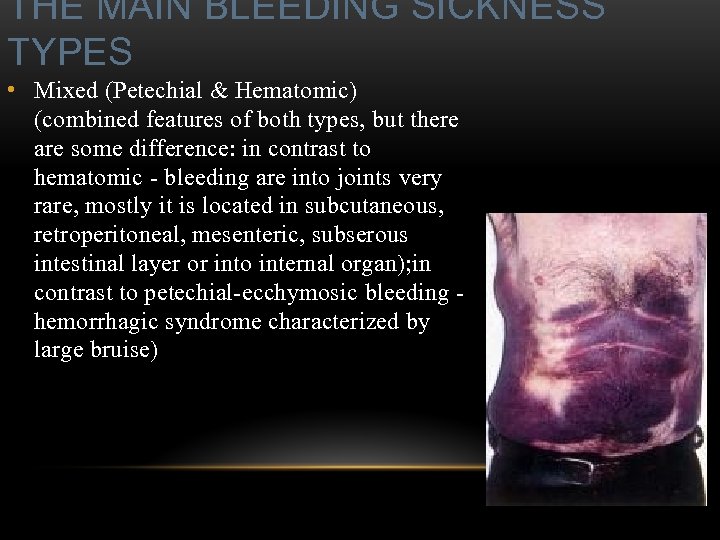 THE MAIN BLEEDING SICKNESS TYPES • Mixed (Petechial & Hematomic) (combined features of both