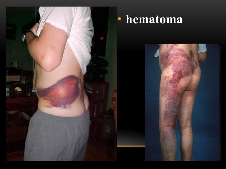  • hematoma 