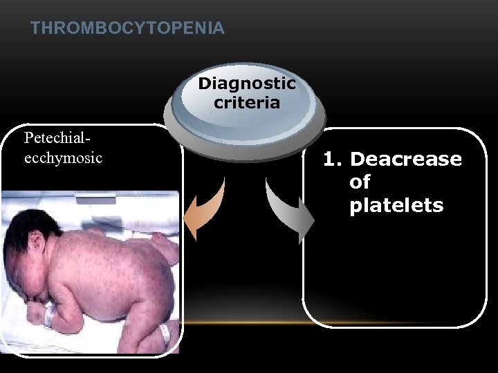 THROMBOCYTOPENIA Diagnostic criteria Petechialecchymosic 1. Deacrease of platelets 