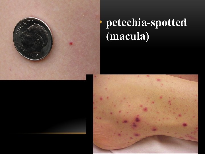  • petechia-spotted (macula) 