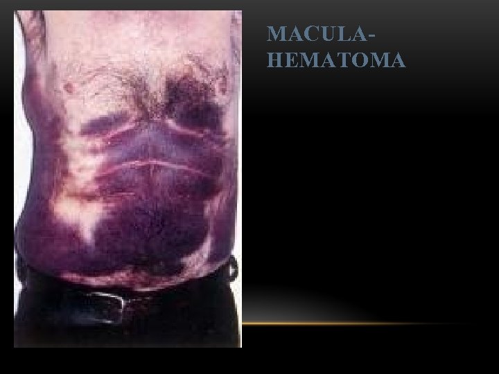 MACULAHEMATOMA 