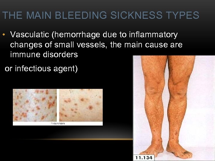 THE MAIN BLEEDING SICKNESS TYPES • Vasculatic (hemorrhage due to inflammatory changes of small