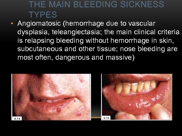 THE MAIN BLEEDING SICKNESS TYPES • Angiomatosic (hemorrhage due to vascular dysplasia, teleangiectasia; the