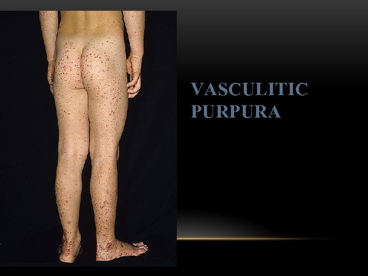 VASCULITIC PURPURA 