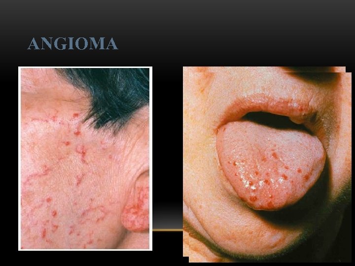 ANGIOMA 