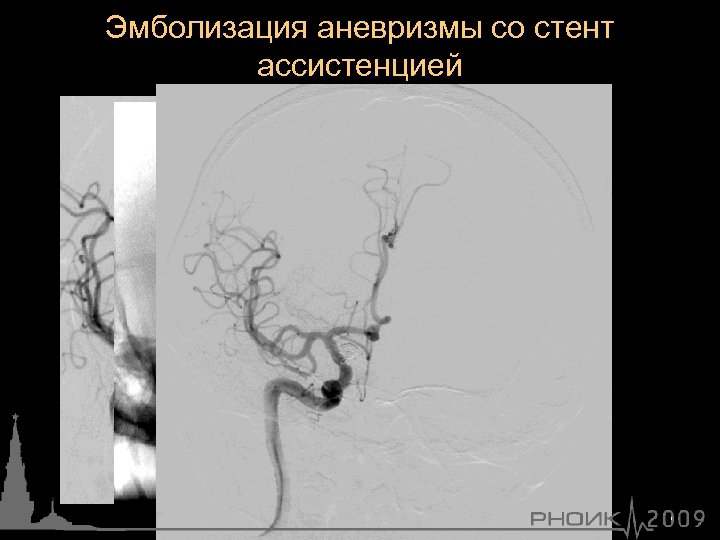 Эмболизация аневризмы со стент ассистенцией 