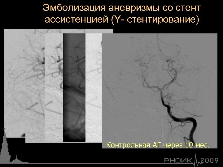Эмболизация аневризмы со стент ассистенцией (Y- стентирование) Контрольная АГ через 10 мес. 