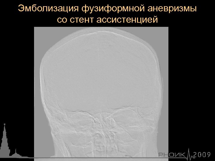 Эмболизация фузиформной аневризмы со стент ассистенцией 