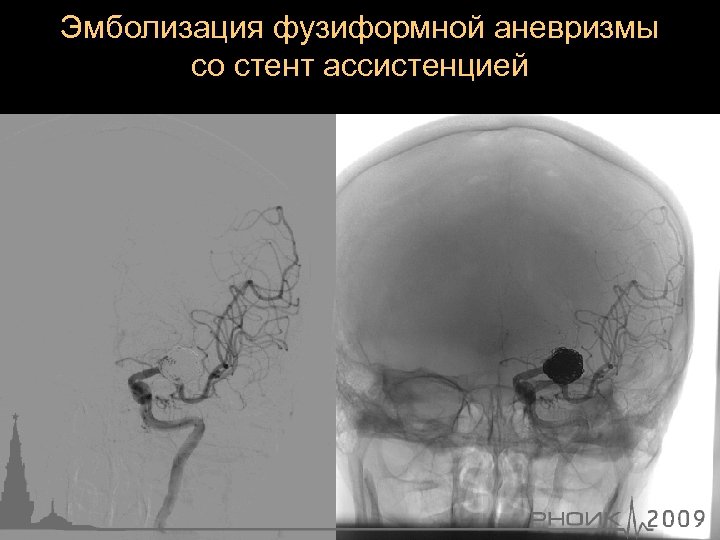 Эмболизация фузиформной аневризмы со стент ассистенцией 