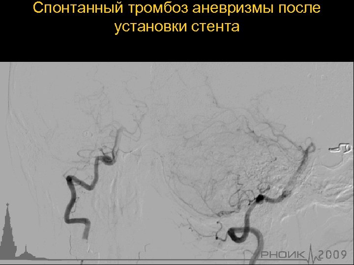 Спонтанный тромбоз аневризмы после установки стента 