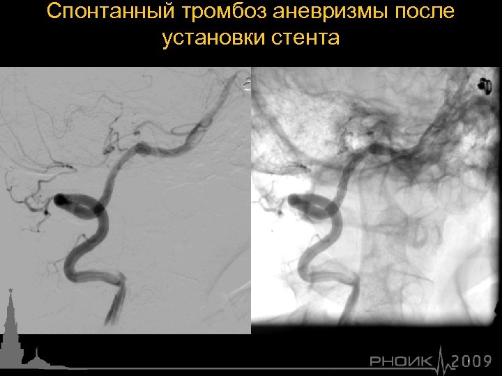Спонтанный тромбоз аневризмы после установки стента 