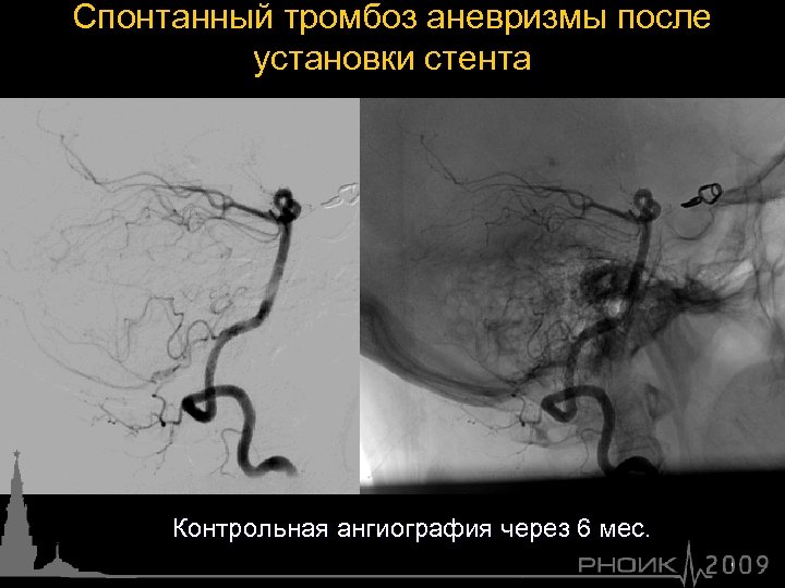 Спонтанный тромбоз аневризмы после установки стента Контрольная ангиография через 6 мес. 