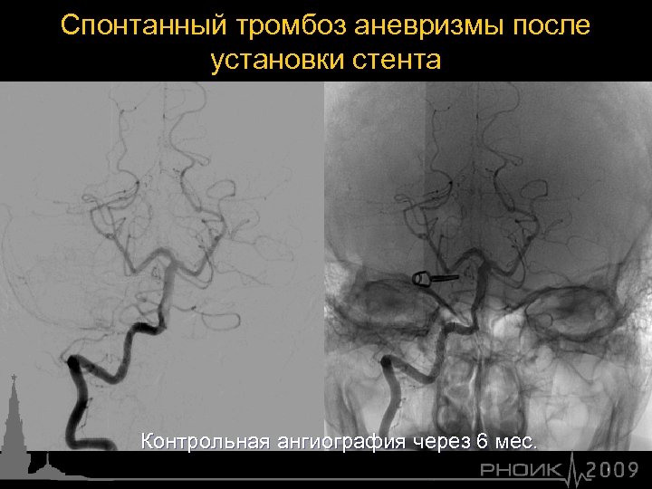 Спонтанный тромбоз аневризмы после установки стента Контрольная ангиография через 6 мес. 