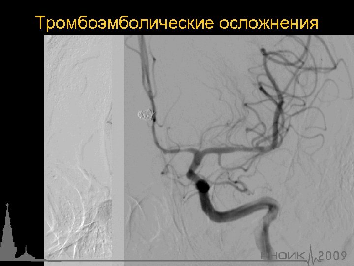 Тромбоэмболические осложнения 