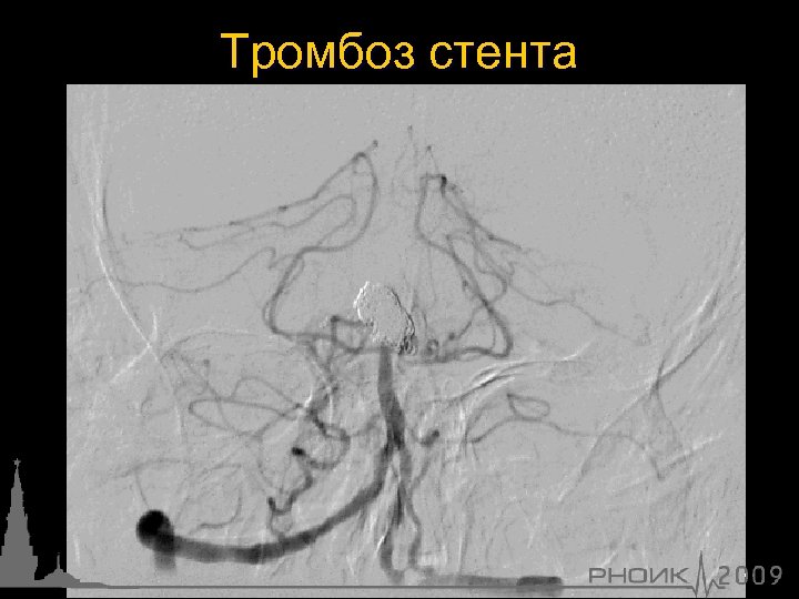 Тромбоз стента 