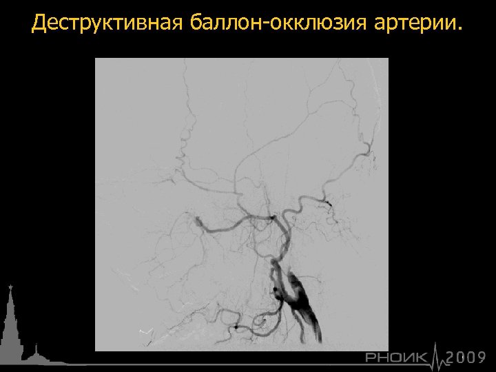 Деструктивная баллон-окклюзия артерии. 
