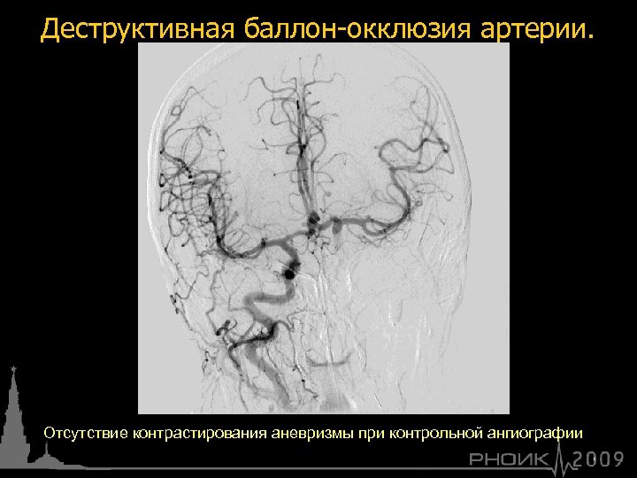 Деструктивная баллон-окклюзия артерии. Отсутствие контрастирования аневризмы при контрольной ангиографии 