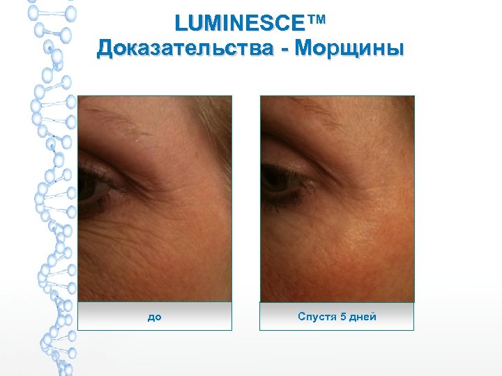 LUMINESCE™ Доказательства - Морщины до Спустя 5 дней 