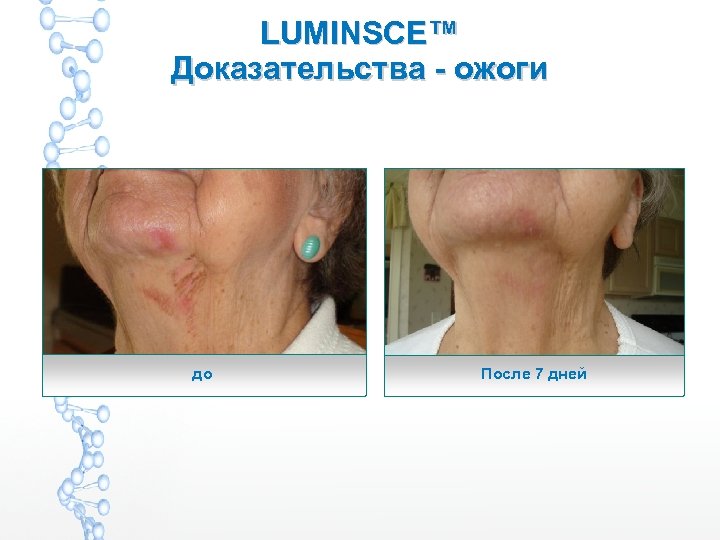 LUMINSCE™ Доказательства - ожоги до После 7 дней 
