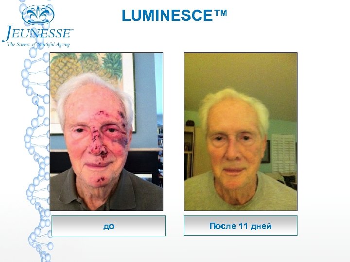LUMINESCE™ до После 11 дней 