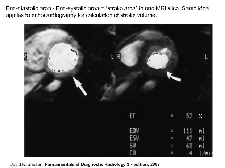 End-diastolic area - End-systolic area = “stroke area” in one MRI slice. Same idea