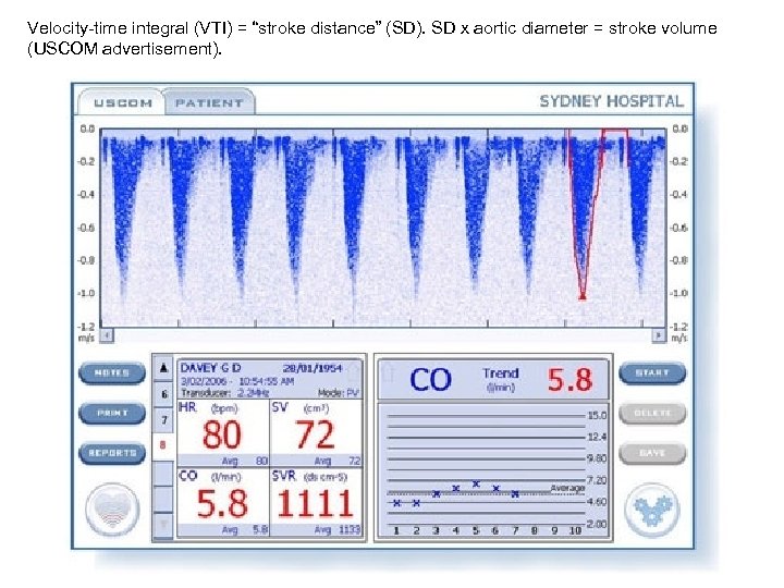 Velocity-time integral (VTI) = “stroke distance” (SD). SD x aortic diameter = stroke volume