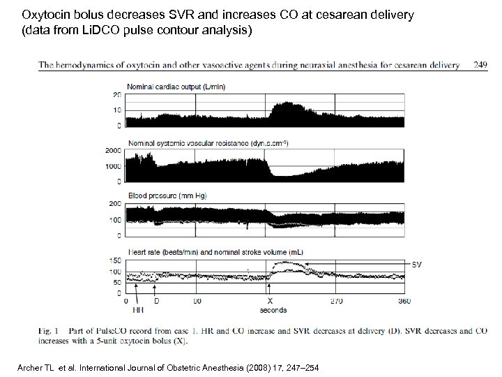 Oxytocin bolus decreases SVR and increases CO at cesarean delivery (data from Li. DCO