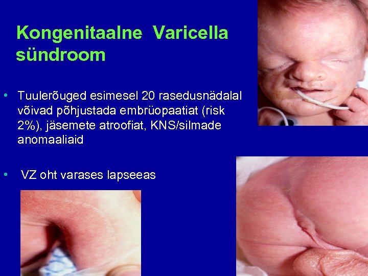 Kongenitaalne Varicella sündroom • Tuulerõuged esimesel 20 rasedusnädalal võivad põhjustada embrüopaatiat (risk 2%), jäsemete