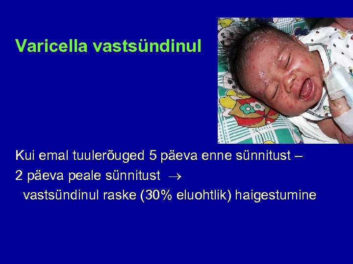 Varicella vastsündinul Kui emal tuulerõuged 5 päeva enne sünnitust – 2 päeva peale sünnitust