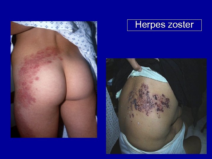 Herpes zoster 