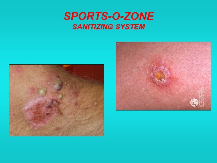 SPORTS-O-ZONE SANITIZING SYSTEM 