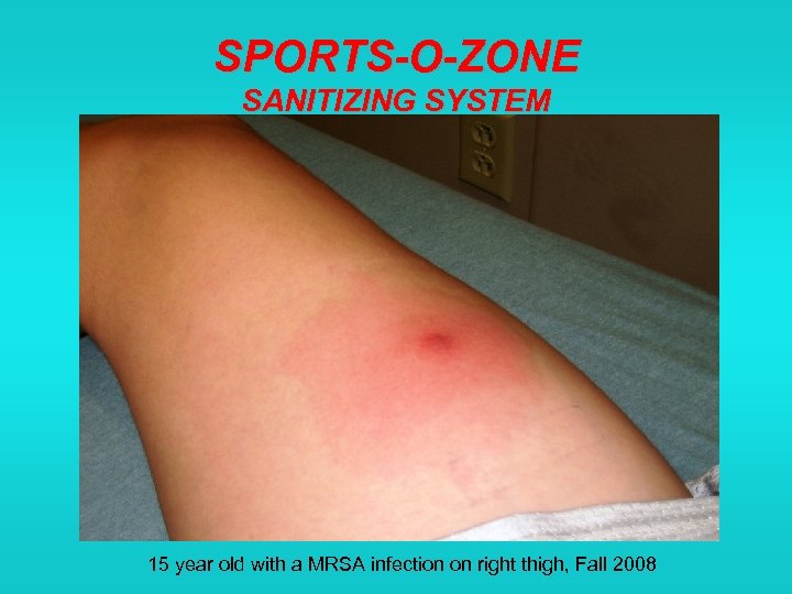 SPORTS-O-ZONE SANITIZING SYSTEM 15 year old with a MRSA infection on right thigh, Fall