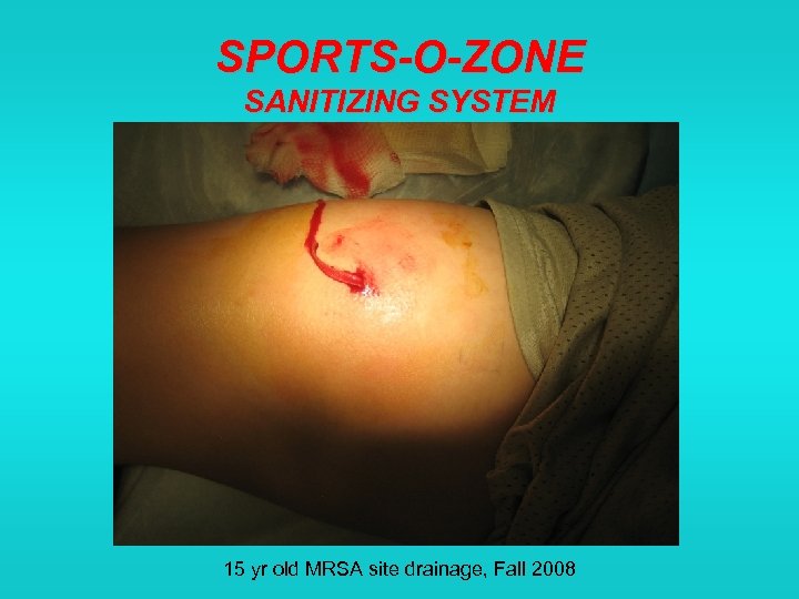 SPORTS-O-ZONE SANITIZING SYSTEM 15 yr old MRSA site drainage, Fall 2008 