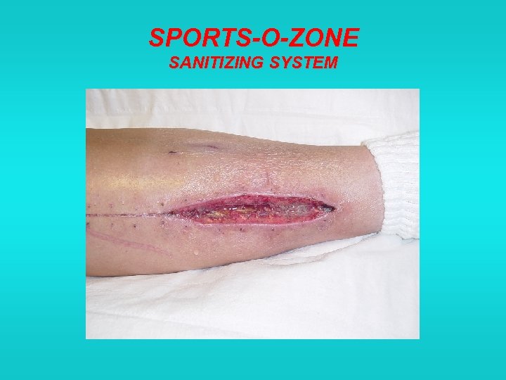 SPORTS-O-ZONE SANITIZING SYSTEM 