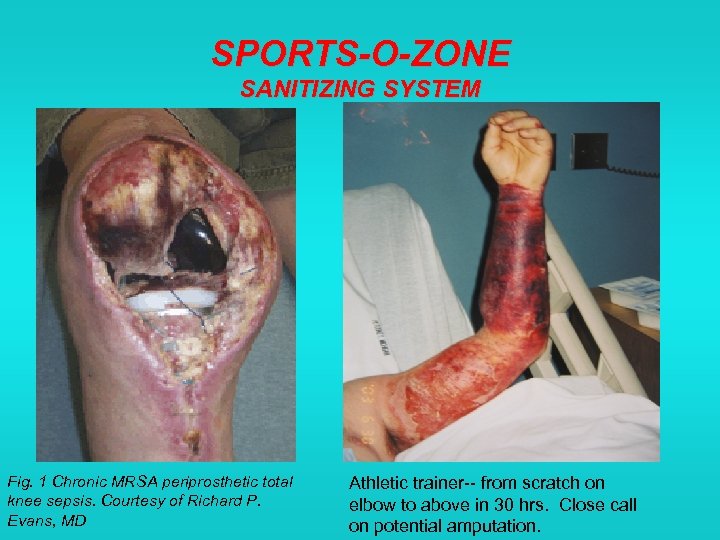 SPORTS-O-ZONE SANITIZING SYSTEM Fig. 1 Chronic MRSA periprosthetic total knee sepsis. Courtesy of Richard